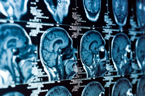 Aqressiv beyin xərçənginin müalicəsində irəliləyiş əldə olunub