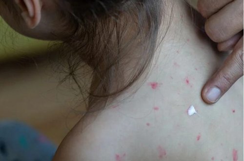 Ölümcül xəstəlik hallarının sayı artır: Peyvəndsiz tətilə getməyin