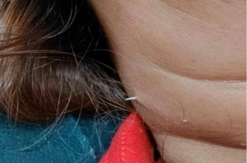 Boynundan udduğu balıq sümüyü çıxdı