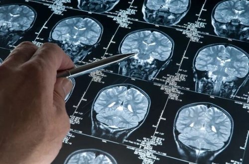 Psixopatların beyni digər insanlardan fərqlidir