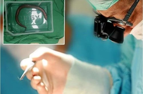 Qarın ağrısı ilə xəstəxanaya müraciət etdi, mədəsində diri ilan balığı tapıldı