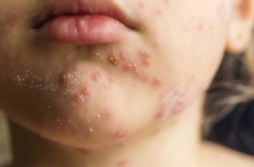 ABŞ-də qızılcaya yoluxma 33 ilin ən yüksək səviyyəsinə çatdı