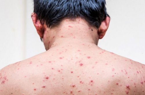 Azərbaycanda suçiçəyinə yoluxma sayı artıb - RƏSMİ