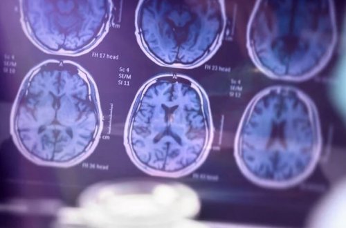 Alzheimer xəstəliyi artıq ölümcül bir xəstəlik deyil