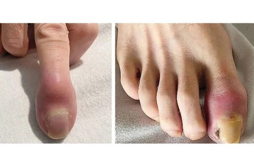 Ağciyər xərçəngi barmaqlarını şişirdib