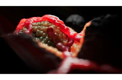 Mütəxəssislər bağırsaq xərçəngi riskini artıran əsas səbəbini dedilər