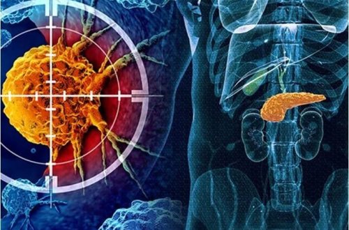 Mədəaltı vəzi xərçəngi üçün qeyri-adi peyvənd kəşf edildi