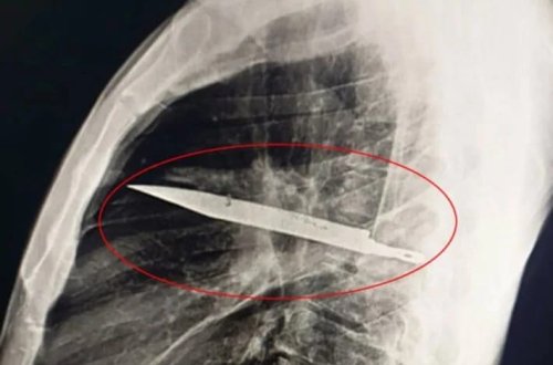 Ağrıdan şikayət edərək xəstəxanaya getdi, sinəsindən bıçaq tapıldı