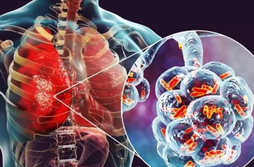 Ötən il Azərbaycanda pnevmoniyaya yoluxan 400-dən çox şəxs ölüb