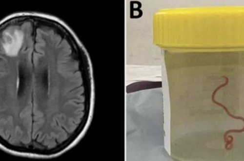 Gölməçələrdə və çaylarda tapılan qurd şizofreniya xəstəliyinin müalicəsində istifadə edilə bilər