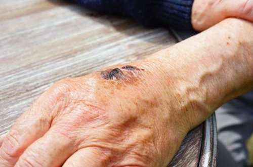 Ötən il Azərbaycanda qarayaraya yoluxanların sayı artıb