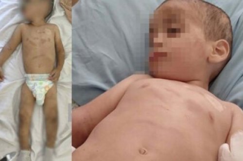 Döyülən azyaşlının vəziyyəti hələ də ağırdır