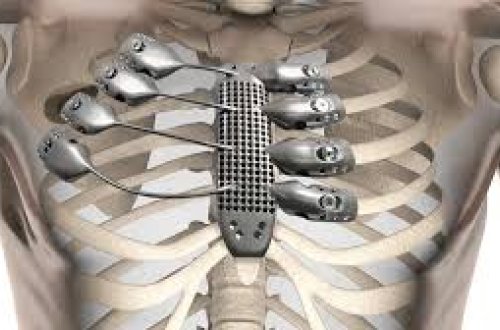 Zədələnmiş sümüklərin sürətli bərpasına imkan verən cihaz yaradılıb