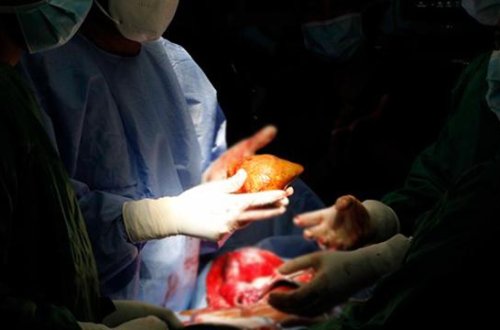 Bütün qan qruplarına uyğun universal böyrək hazırlandı