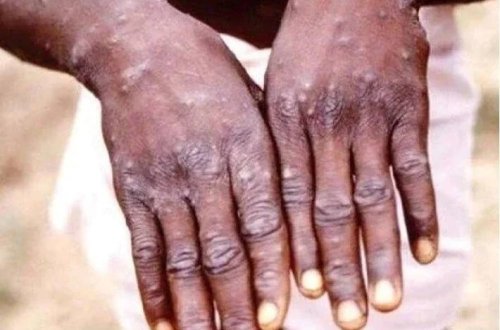 Namibiyada ilk M çiçəyi hadisəsi aşkar edilib