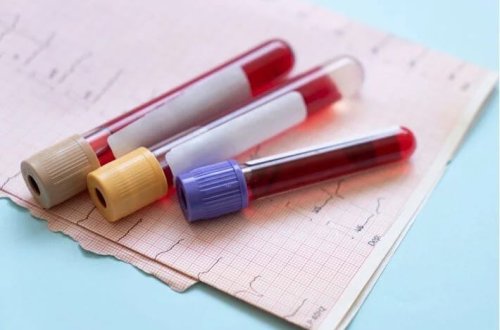 Erkən diaqnozda inqilab: 50-dən çox xərçəng növünü aşkar edən qan testi