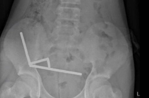 200 maqnit uddu, bağırsağının bir hissəsini itirdi