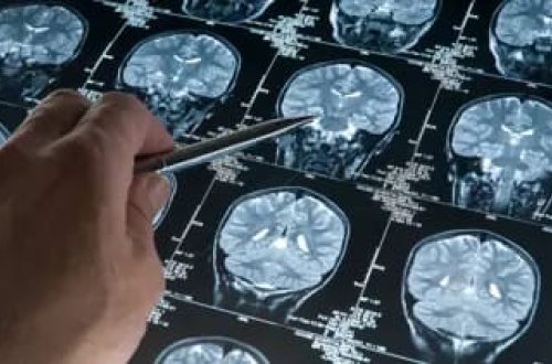 Yeni nevroloji xəstəlik aşkar edilib: Yalnız 13 nəfərdə müşahidə edilib