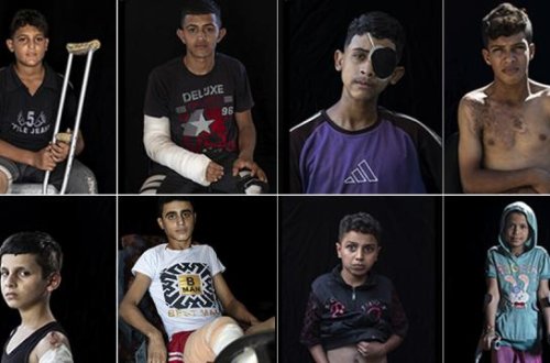 Qəzzada 5 mindən çox uşaq amputasiya edilib