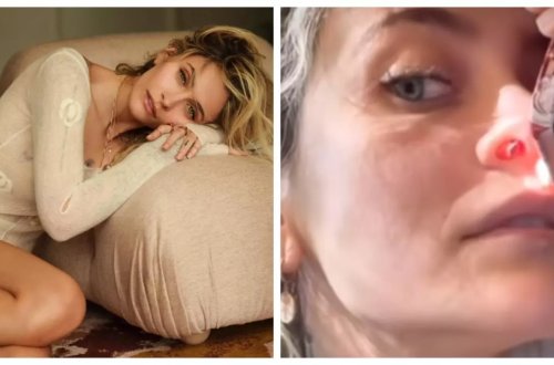 Narkotik Ceksonun qızının burnunda dəlik açdı, əməliyyatdan imtina etdi