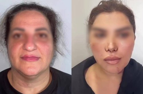 60 yaşlı qadını əməliyyatla bu hala saldılar - VİDEO