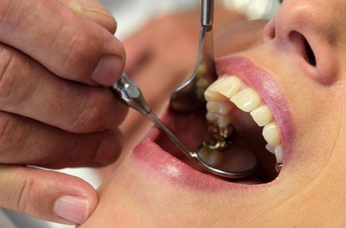 Sadə bir diş çürüməsi nəyə səbəb ola bilər?