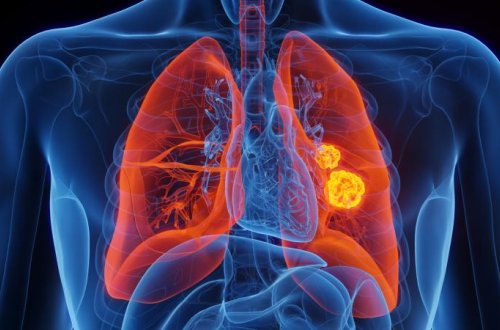 Əgər tədbirlər görülməsə, xərçəngdən ölümlərin 2050-ci ilə qədər iki dəfə artacağı gözlənilir