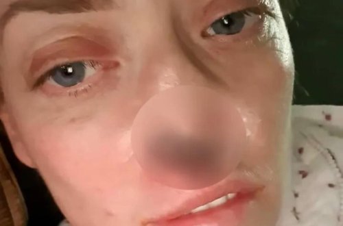 Türkiyədə implant etdirən qadının burnu çürüməyə başladı - VİDEO