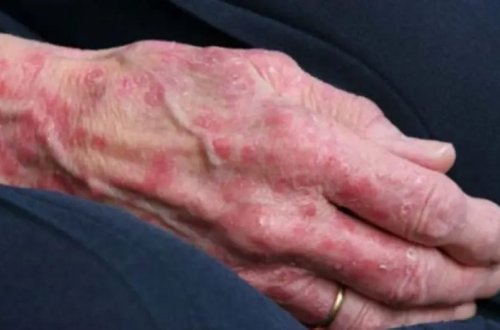 Rumıniya və Xorvatiyada cüzəm halları qeydə alınıb: 40 ildən sonra ilk hadisə