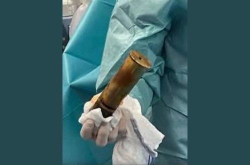 24 yaşlı oğlanın düz bağırsağından Birinci Dünya Müharibəsindən qalma top mərmisi çıxarılıb
