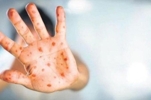 Sankt-Peterburqda iki nəfərdə meymunçiçəyi virusu aşkarlanıb