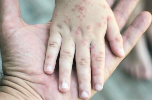 Bakıda uşaq evində azyaşlı qızılcadan ÖLDÜ