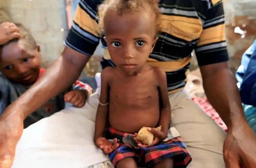 Yəməndə qızılca epidemiyası: 36 uşaq ölüb