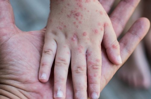 ÜST-dən xəbərdarlıq - bu xəstəliyə yoluxma yenidən artmağa başlayıb