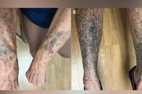 Antibiotik qəbul edən qadın görün nə hala DÜŞDÜ