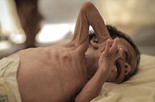 Banqladeşdə qızılcadan ölən uşaqların sayı 409-a yüksəlib