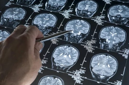 Alzheimer tədqiqatında təəccüblü irəliləyiş! Həll misdə ola bilər