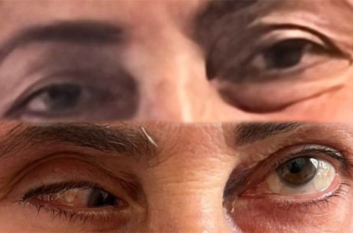 Bu klinika təzminat ödəyəcək – Burun düzəldəndə gözü zədələyib