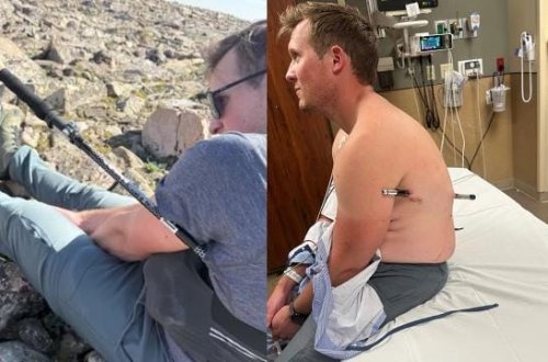 Bədəninə yürüş çubuğu batmış alpinist 16 kilometr yol qət edib