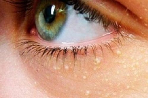 Üzdəki sarı ləkələr ürək tutması və insult riskindən xəbər verir