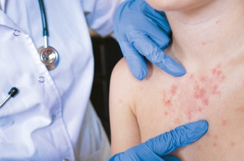 ABŞ-da qızılca epidemiyası ilə bağlı xəbərdarlıq